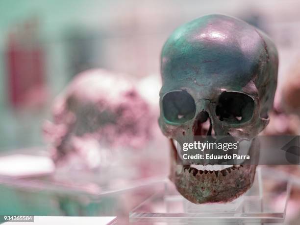 Human skull affected by copper is exhibited at the 'Cosmos' exhibition at the National Library of Spain on March 19, 2018 in Madrid, Spain.