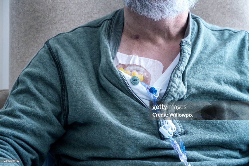 Patient atteint de cancer avec la chimiothérapie médicaments intraveineux cœlio
