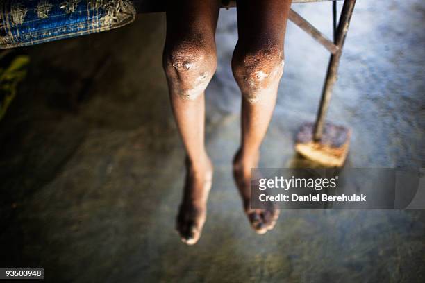 Year old Sachin Kumar's sits a he waits to have his sores cleaned at his home in a slum near the site of the deserted Union Carbide factory on...