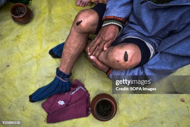 Patient receives leech therapy in Srinagar. Every year traditional health workers in Indian administered Kashmir use leeches to treat people for...