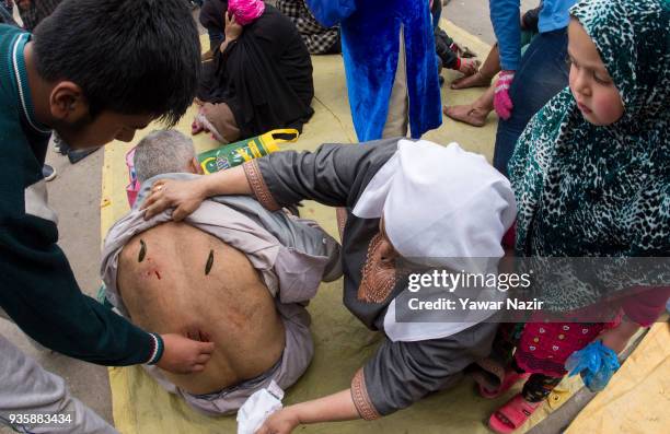 Girl looks on as her grandfather receives leech therapy from a practitioner, on March 21 in Srinagar, the summer capital of Indian administered...