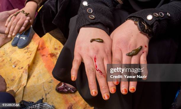 Kashmiri Muslim women receive leech therapy on their hands from a practitioner, on March 21 in Srinagar, the summer capital of Indian administered...