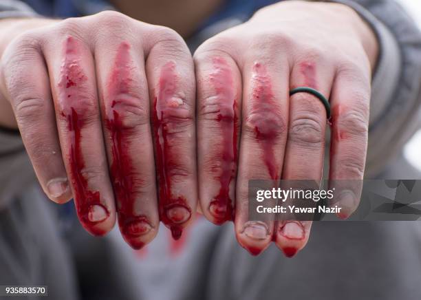 Blood oozes from the fingers of a Kashmiri man after he received leech therapy from a practitioner, on March 21 in Srinagar, the summer capital of...