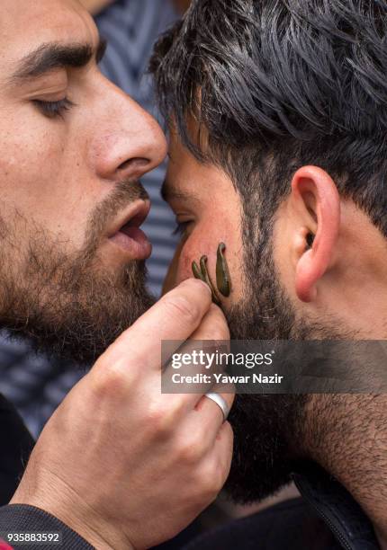 Kashmiri practitioner blows hot air from his mouth on the leeches, as he gives leech therapy to a patient, on March 21 in Srinagar, the summer...