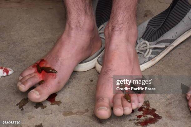 Traditional health workers use leeches to suck blood as part of a treatment at Hazratbal on the banks of the Dal Lake on the outskirts of Srinagar...
