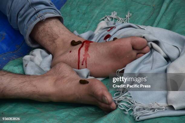 Traditional health workers use leeches to suck blood as part of a treatment at Hazratbal on the banks of the Dal Lake on the outskirts of Srinagar...
