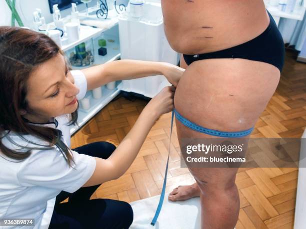 woman using measuring tape to assess leg volume - thigh human leg stock pictures, royalty-free photos & images