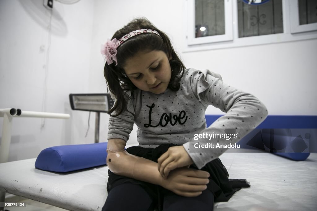 Syrian kid gets her prosthesis via social media