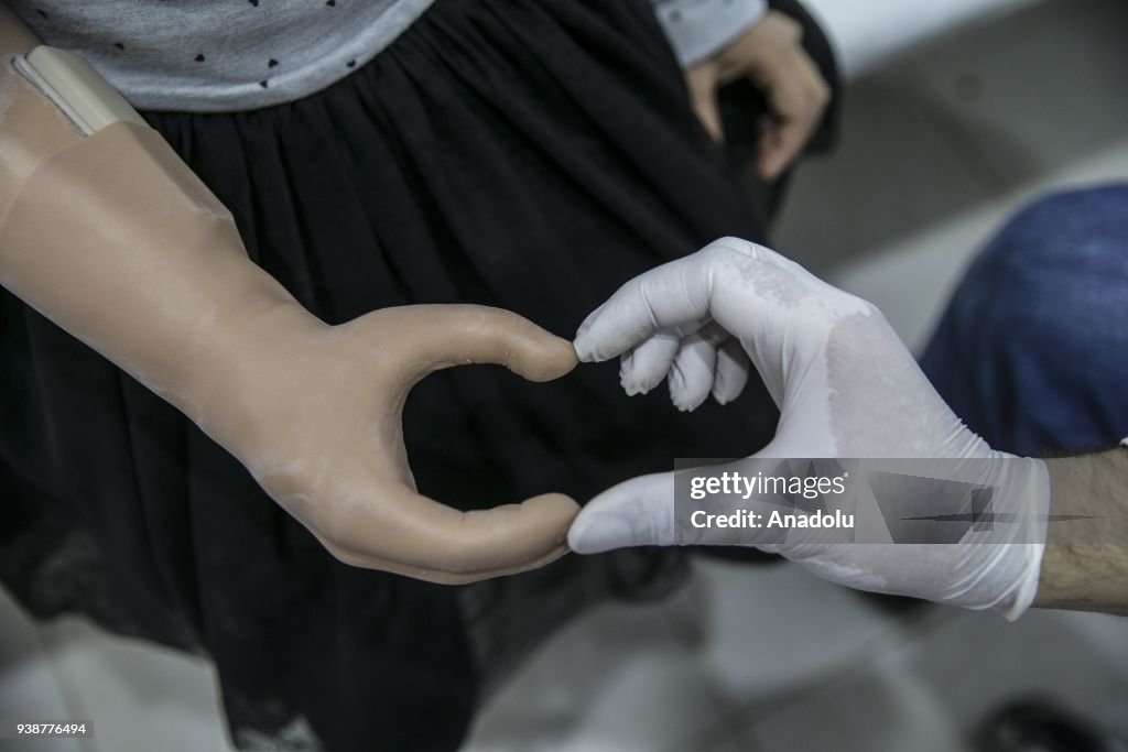 Syrian kid gets her prosthesis via social media