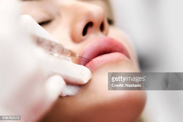 professionell kosmetolog injicera silikon i läppar - botoxinjektion bildbanksfoton och bilder