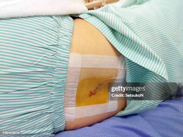 close-up of back, after subarachnoid haemorrhage surgery - backstube stock pictures, royalty-free photos & images