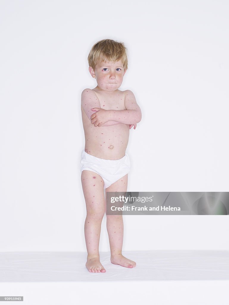 Portrait of toddler boy with chickenpox