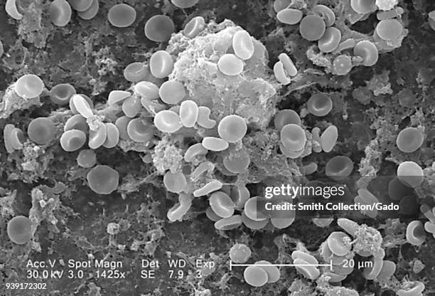 Red blood cells in a fibrinous matrix on the luminal surface of an indwelling vascular catheter revealed in the scanning electron microscopic image...