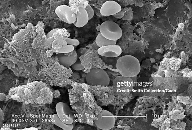 Red blood cells in a fibrinous matrix on the luminal surface of an indwelling vascular catheter revealed in the scanning electron microscopic image,...