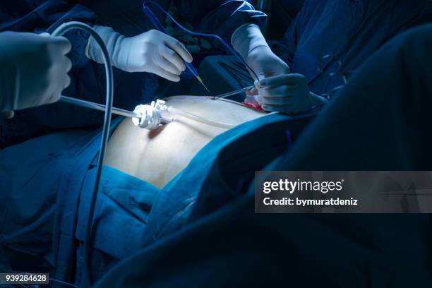 operation using laparoscopic equipment - laparoscopic stock pictures, royalty-free photos & images