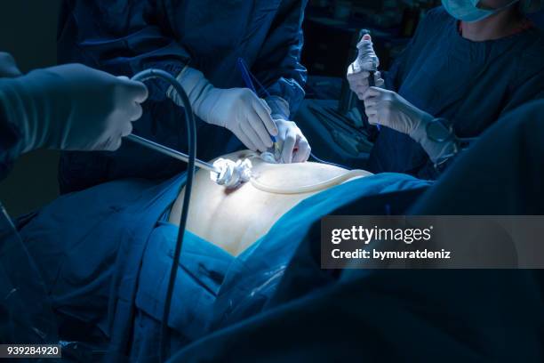 operation using laparoscopic equipment - endoscope stock pictures, royalty-free photos & images