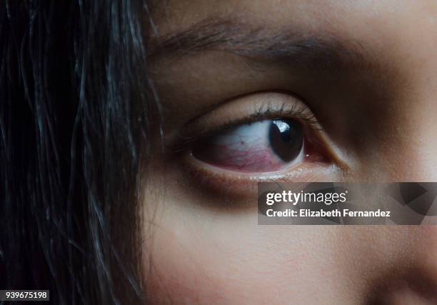 close up of episcleritis eye examination. - bloodshot fotografías e imágenes de stock