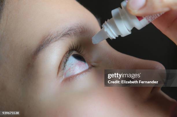 woman applying eye-drops into her eye - bloodshot fotografías e imágenes de stock