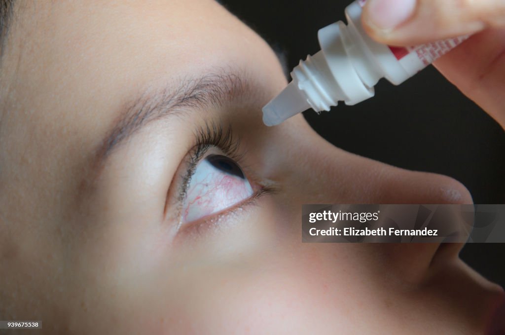 Woman applying eye-drops into her eye