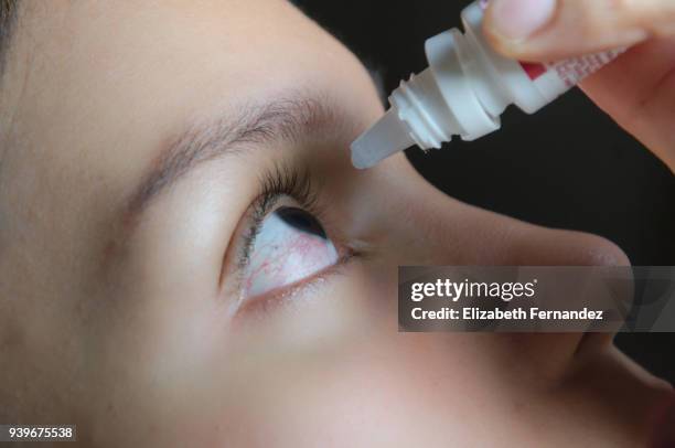 woman applying eye-drops into her eye - bloodshot - fotografias e filmes do acervo