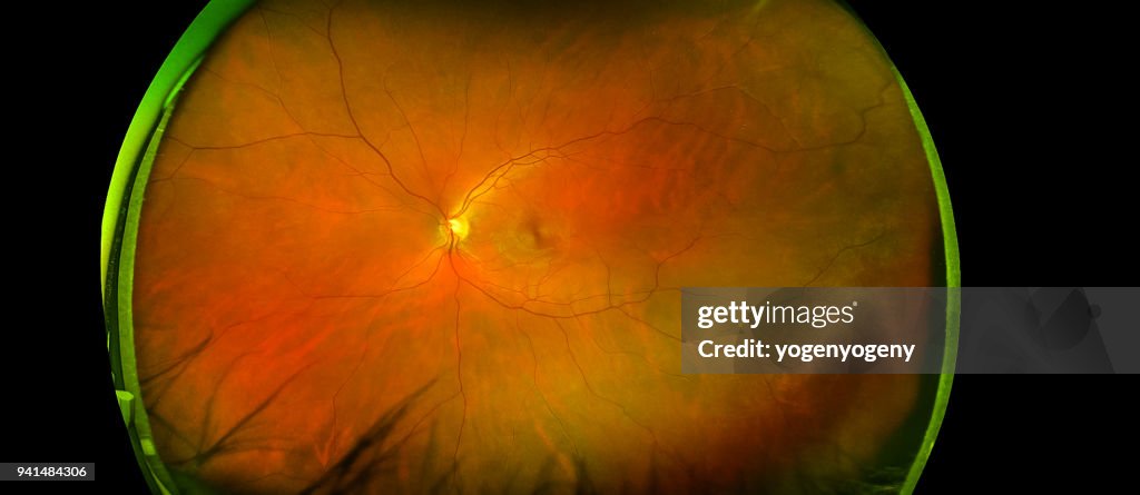 Disc Macula Eyes Retinal Angle Image With Macula Vessels And Optic Disc Isolated ...