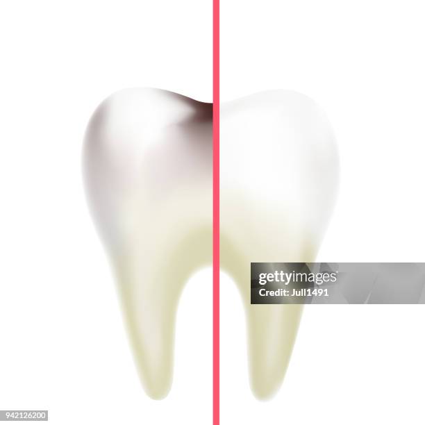 stockillustraties, clipart, cartoons en iconen met verschil tussen een gezond tand en een tand met cariës. realistische molaire tand op witte achtergrond. vectorillustratie. mondhygiëne. - molar