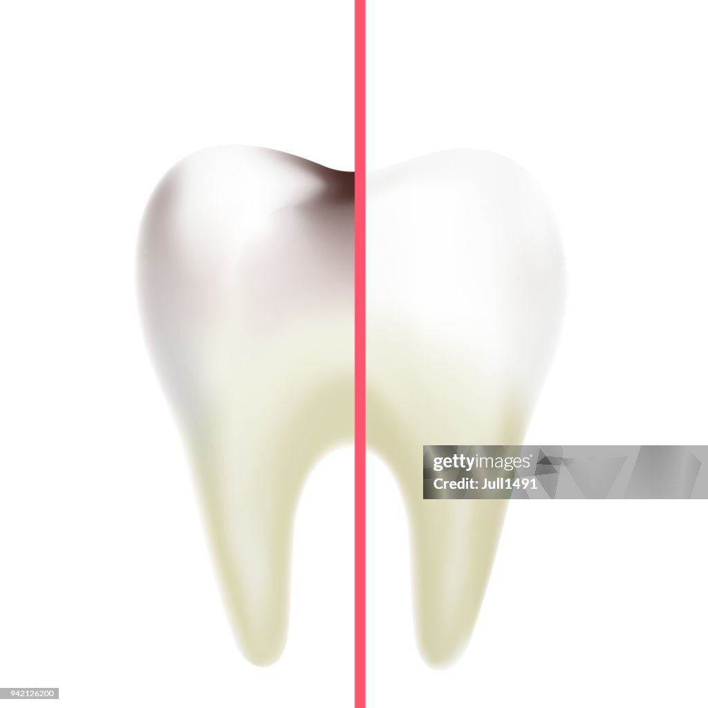 High Tooth Difference Between A Healthy Tooth And A Tooth With Caries Realistic ...