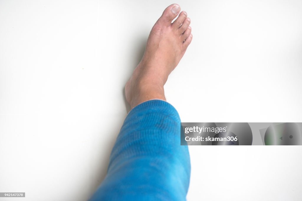Splinter Injury Leg Sport Man Injury Leg With Splint High-Res Stock Photo - Getty Images