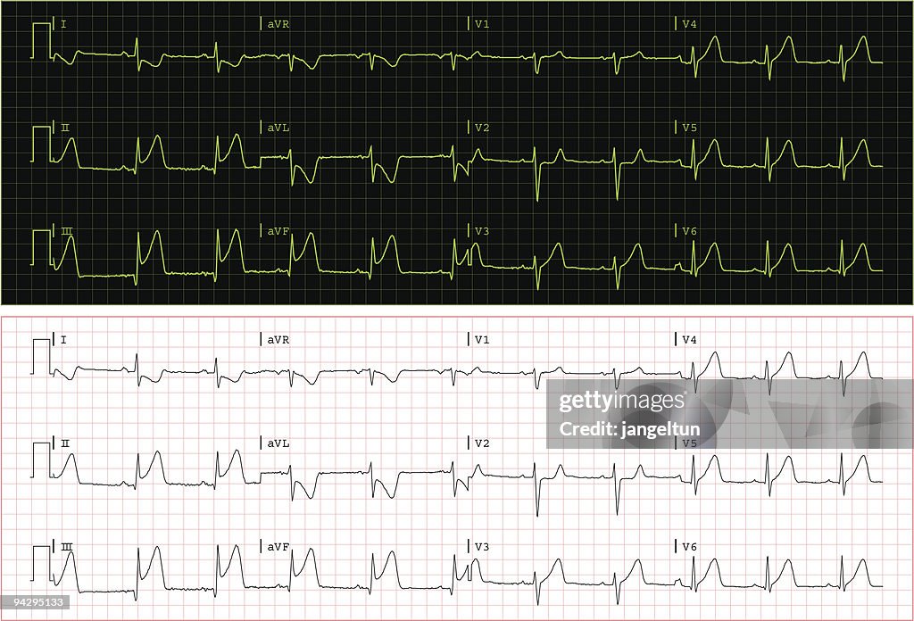 Real ECG (Vektor