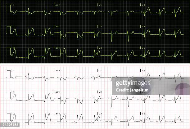 illustrazioni stock, clip art, cartoni animati e icone di tendenza di real ecg (vettore - listening to heartbeat