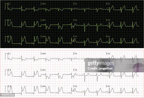 stockillustraties, clipart, cartoons en iconen met real ecg (vector) - gedrukte media