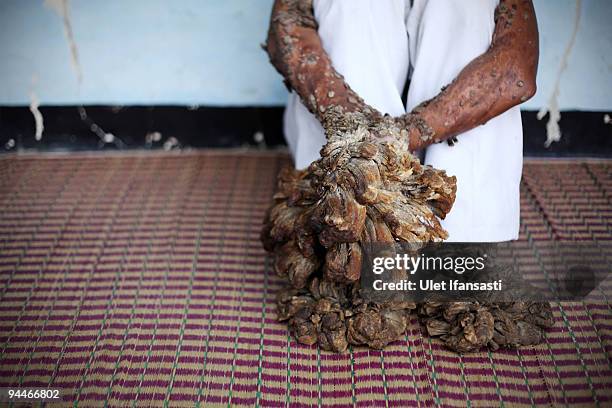 Indonesian man Dede Koswara pose for a photographer in his home village on December 15, 2009 in Bandung, Java, Indonesia. Due to a rare genetic...