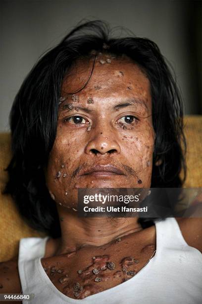 Indonesian man Dede Koswara pose for a photographer in his home village on December 15, 2009 in Bandung, Java, Indonesia. Due to a rare genetic...