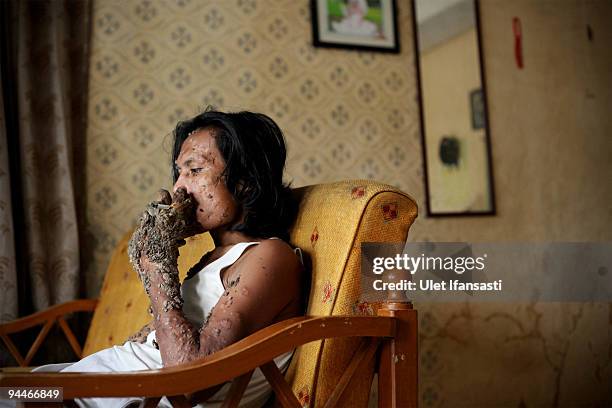 Indonesian man Dede Koswara smokes as he poses for a photographer in his home village on December 15, 2009 in Bandung, Java, Indonesia. Due to a rare...
