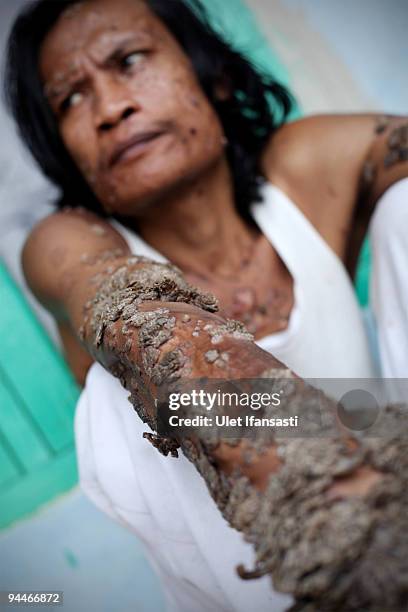 Indonesian man Dede Koswara pose for a photographer in his home village on December 15, 2009 in Bandung, Java, Indonesia. Due to a rare genetic...