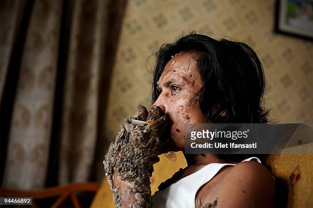 Indonesian man Dede Koswara smokes as he poses for a photographer in his home village on December 15, 2009 in Bandung, Java, Indonesia. Due to a rare...