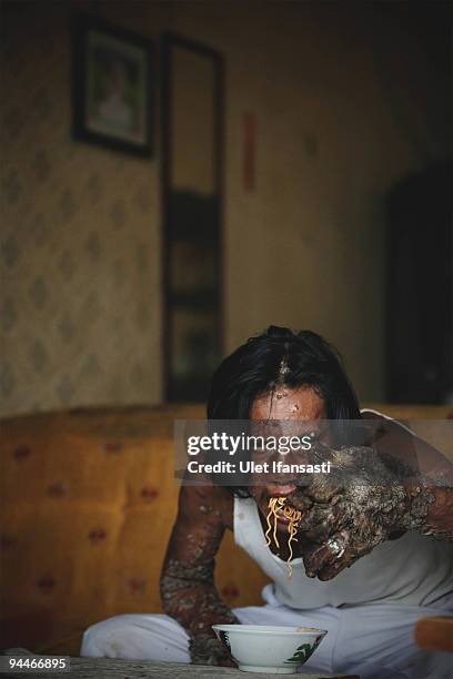 Indonesian man Dede Koswara eats as he poses for a photographer in his home village on December 15, 2009 in Bandung, Java, Indonesia. Due to a rare...