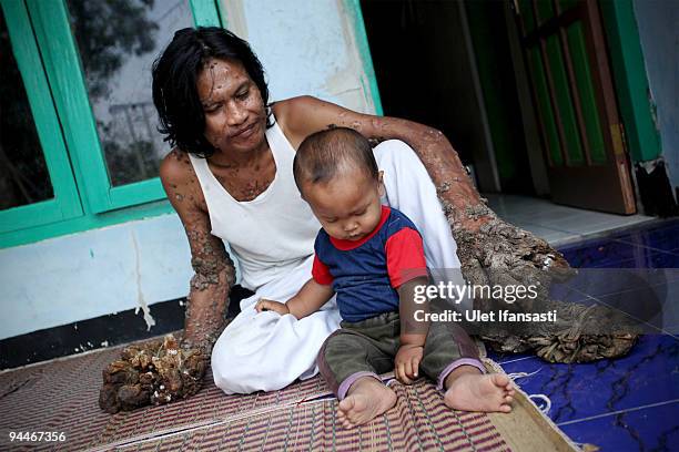 Indonesian man Dede Koswara pose for a photographer in his home village on December 15, 2009 in Bandung, Java, Indonesia. Due to a rare genetic...