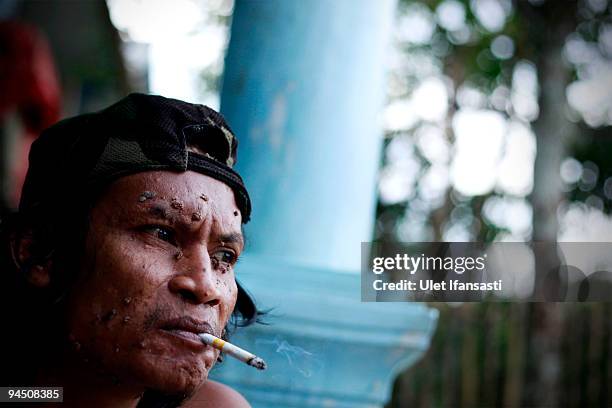 Indonesian man Dede Koswara smoking in his home village on December 16, 2009 in Bandung, Java, Indonesia. Due to a rare genetic problem with Dede�s...