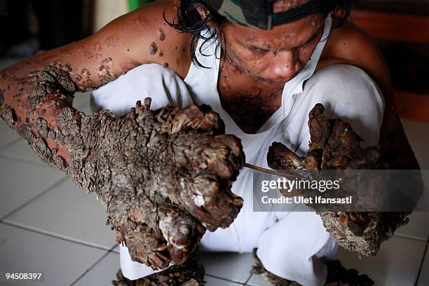 Indonesian man Dede Koswara treat illness in his home village on December 16, 2009 in Bandung, Java, Indonesia. Due to a rare genetic problem with...