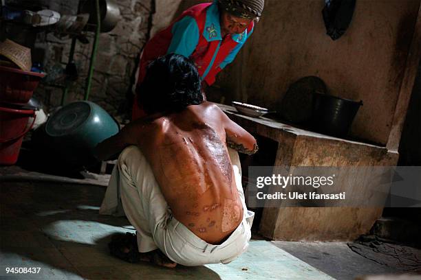 Indonesian man Dede Koswara prepare for shower in his home village on December 16, 2009 in Bandung, Java, Indonesia. Due to a rare genetic problem...