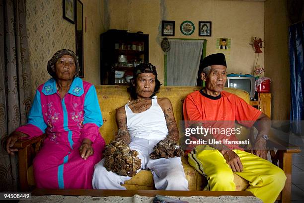 Indonesian man Dede Koswara with his parents is seen in his home village on December 16, 2009 in Bandung, Java, Indonesia. Due to a rare genetic...