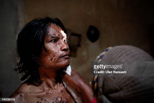 Indonesian man Dede Koswara shower in his home village on December 16, 2009 in Bandung, Java, Indonesia. Due to a rare genetic problem with Dede's...