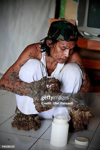 Indonesian man Dede Koswara treat illness in his home village on December 16, 2009 in Bandung, Java, Indonesia. Due to a rare genetic problem with...