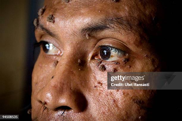 Indonesian man Dede Koswara pose on photographer in his home village on December 16, 2009 in Bandung, Java, Indonesia. Due to a rare genetic problem...