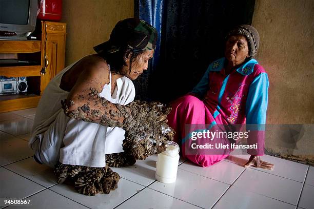 Indonesian man Dede Koswara treat illness with his mother named Engkar in his home village on December 16, 2009 in Bandung, Java, Indonesia. Due to a...