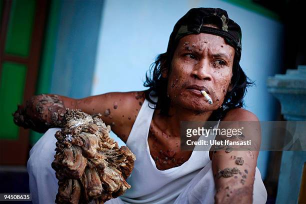 Indonesian man Dede Koswara smoking in his home village on December 16, 2009 in Bandung, Java, Indonesia. Due to a rare genetic problem with Dede�s...