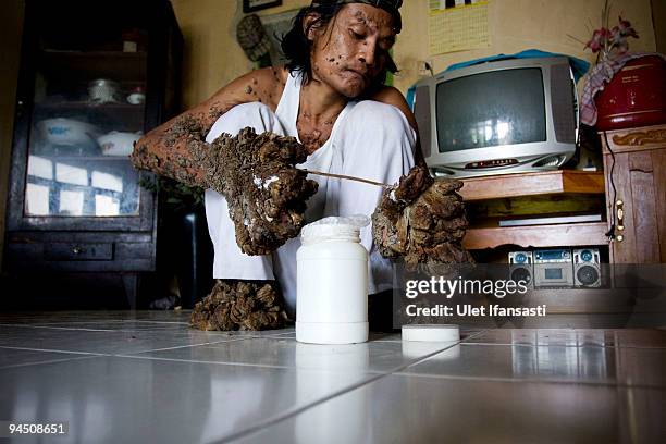 Indonesian man Dede Koswara treat illness in his home village on December 16, 2009 in Bandung, Java, Indonesia. Due to a rare genetic problem with...