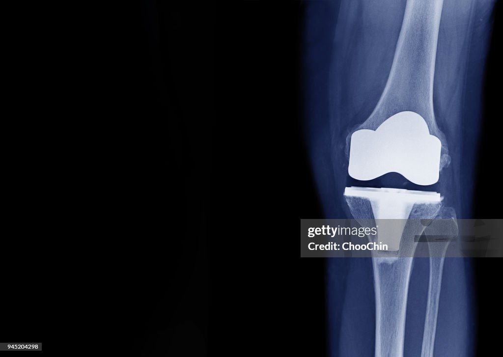 X-ray show knee joint replacement / knee arthroplasty front view and blank area at left side