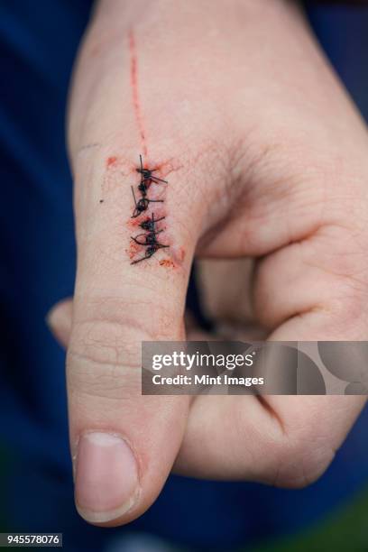 close-up of an injured left thumb with stitches on the wound. - injured hand stock pictures, royalty-free photos & images